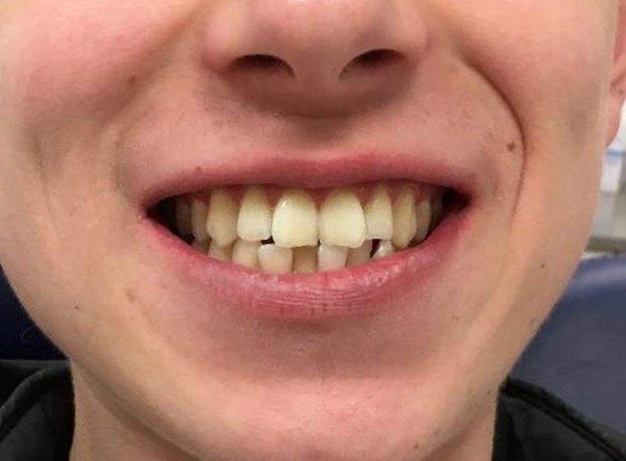 Alex - 6 month braces - before